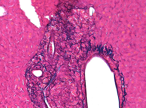 図３　マウス腫瘍の肝臓転移（パラフィン切片・アザン染色法）